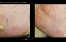 Стержневая мозоль