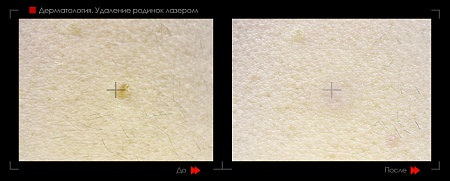 Удаление родинок 39 фото до и после процедуры