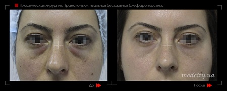 Блефаропластика 12 фото до и после процедуры