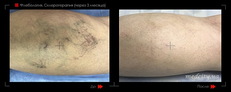 Склеротерапия 14 фото до и после процедуры