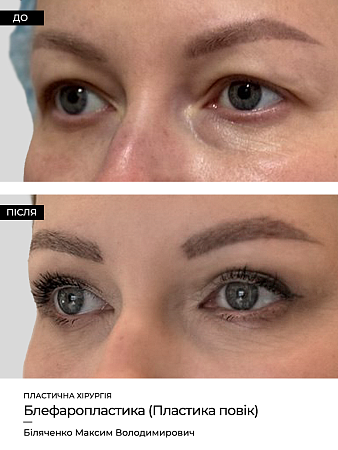 Блефаропластика  фото до и после процедуры