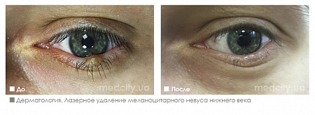 Лазерное удаление меланоцитарного невуса нижнего века фото до и после процедуры
