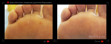 Лазерное удаление бородавок 13 фото до и после процедуры