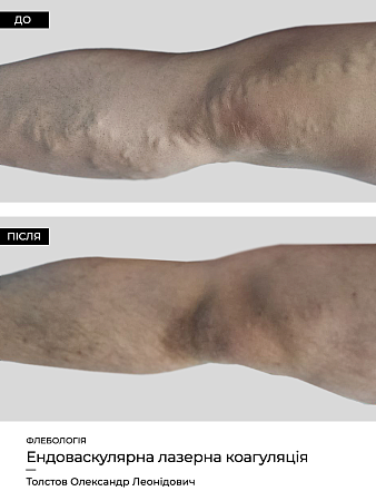 Эндоваскулярная лазерная коагуляция18 фото до и после процедуры