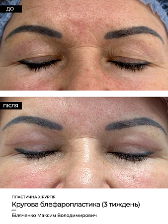 Блефаропластика фото до и после процедуры