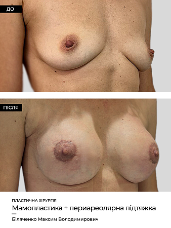 Mammoplastika 4 фото до и после процедуры