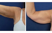 Липосакция рук