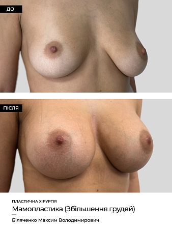 Маммопластика 37 фото до и после процедуры