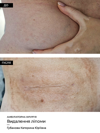 Видалення ліпоми фото до и после процедуры