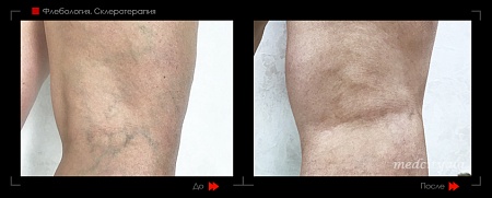 Склеротерапия 20 фото до и после процедуры
