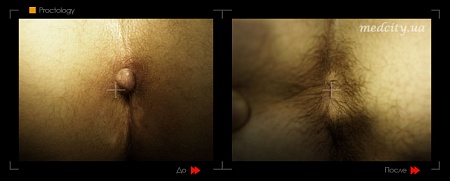 Lechenie gemorroya 1 фото до и после процедуры