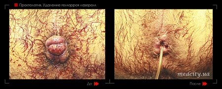 Удаление геморроя лазером 18 фото до и после процедуры