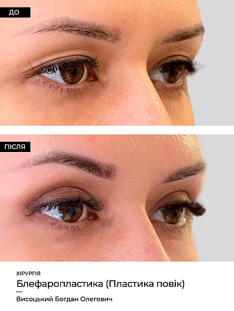 Блефаропластика 17 фото до и после процедуры