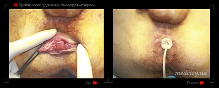 Удаление геморроя лазером 16 фото до и после процедуры