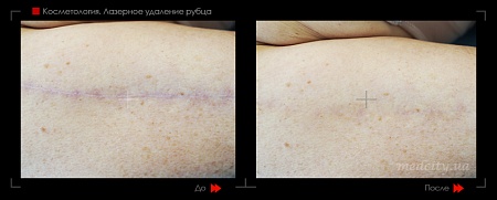Шлифовка рубца 13 фото до и после процедуры