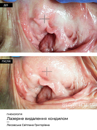 Удаление кондилом (гинек.) 9 фото до и после процедуры