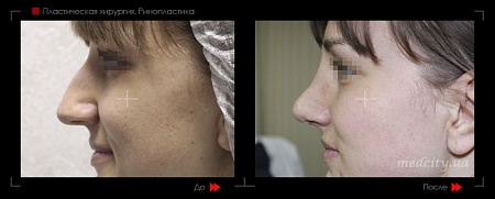 Ринопластика 10 фото до и после процедуры