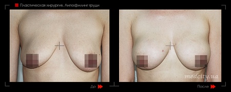 Липофилинг груди 6 фото до и после процедуры