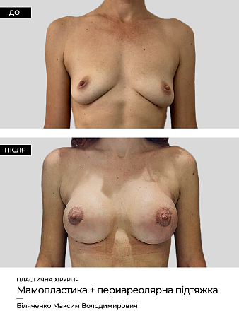 Mammoplastika 3 фото до и после процедуры