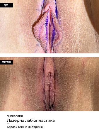 Лабиопластика 51 фото до и после процедуры