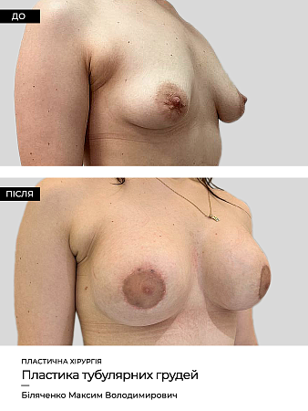 Mammoplastika 6 фото до и после процедуры