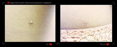 Удаление родинок 40 фото до и после процедуры