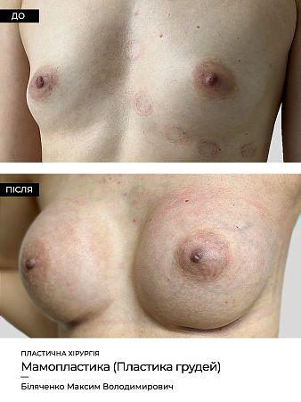Маммопластика 25 фото до и после процедуры