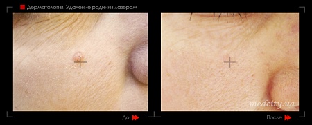 Удаление родинок 74 фото до и после процедуры
