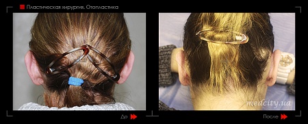 Отопластика 12 фото до и после процедуры