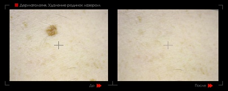 Удаление родинок 38 фото до и после процедуры