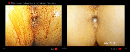 Удаление геморроя лазером 24 фото до и после процедуры