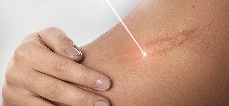 Лазерное удаление рубцов
