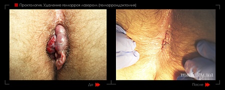 Удаление геморроя лазером 28 фото до и после процедуры