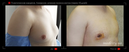 Гинекомастия 52 фото до и после процедуры