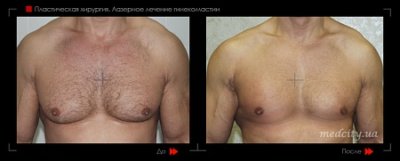 Гинекомастия 44 фото до и после процедуры