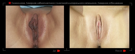 Лабиопластика 34 фото до и после процедуры