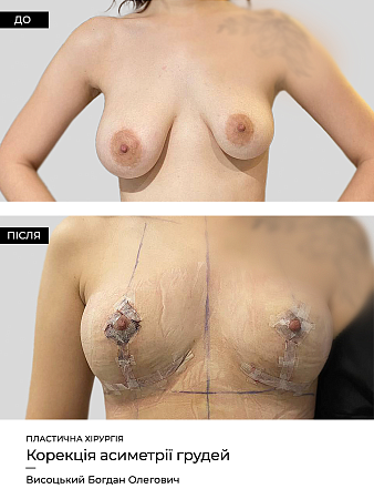 Коррекция ареол фото до и после процедуры