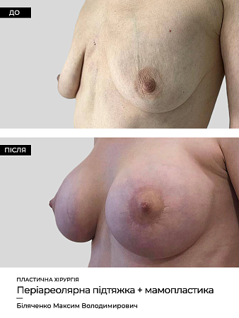 Mammoplastika 7 фото до и после процедуры