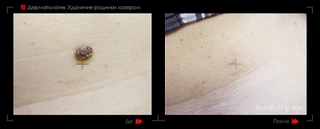 Удаление родинок 62 фото до и после процедуры
