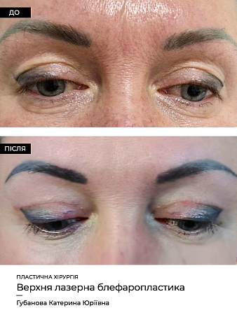 Блефаропластика 26 фото до и после процедуры