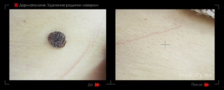 Удаление родинок19 фото до и после процедуры