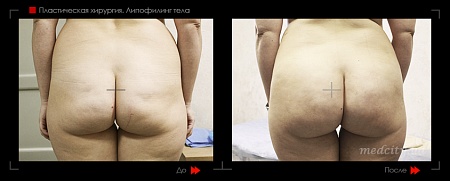 Липофилинг тела 4 фото до и после процедуры