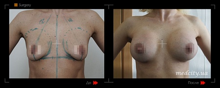 Mammoplastika 10 фото до и после процедуры