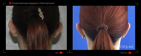 Отопластика 25 фото до и после процедуры