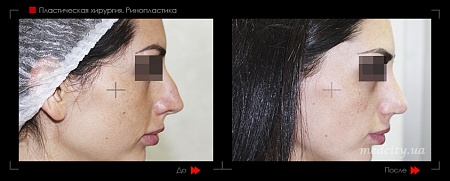 Ринопластика 22 фото до и после процедуры