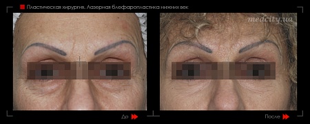 Блефаропластика нижнего века 3 фото до и после процедуры