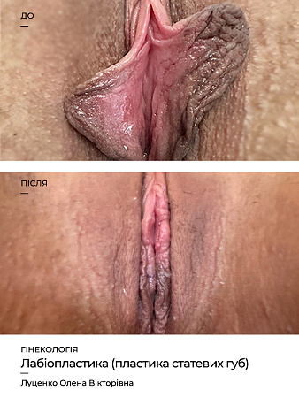 Лабіопластика фото до и после процедуры
