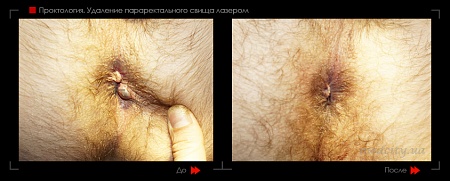 Удаление свища 4 фото до и после процедуры