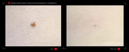 Удаление родинок 66 фото до и после процедуры