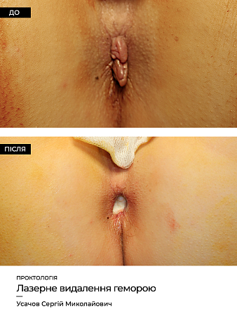 Lechenie gemorroya 2 фото до и после процедуры